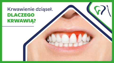 Krwawienie dziąseł – dlaczego krwawią? Przyczyny i zapobieganie