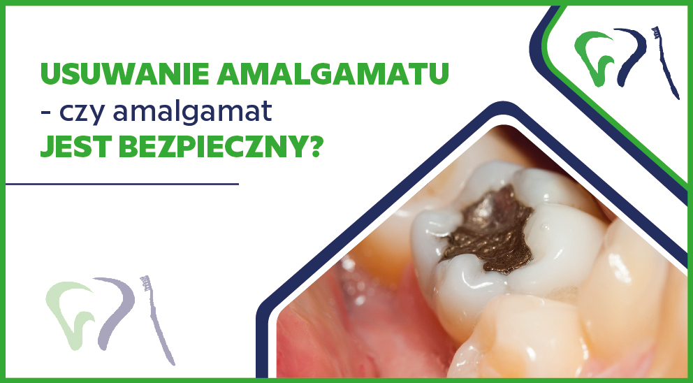 Usuwanie amalgamatu - czy amalgamat jest bezpieczny?